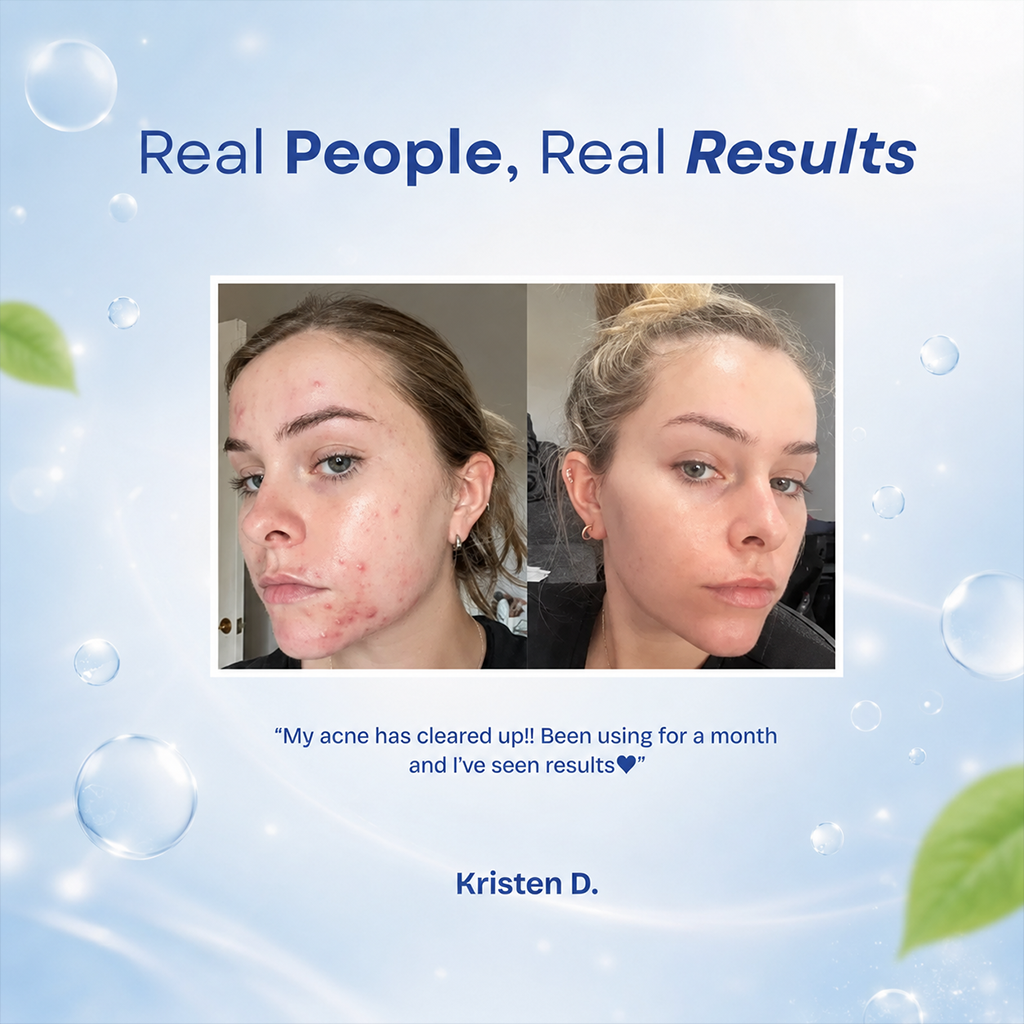 Acne Treatment-Pimples Removal Cream Pair