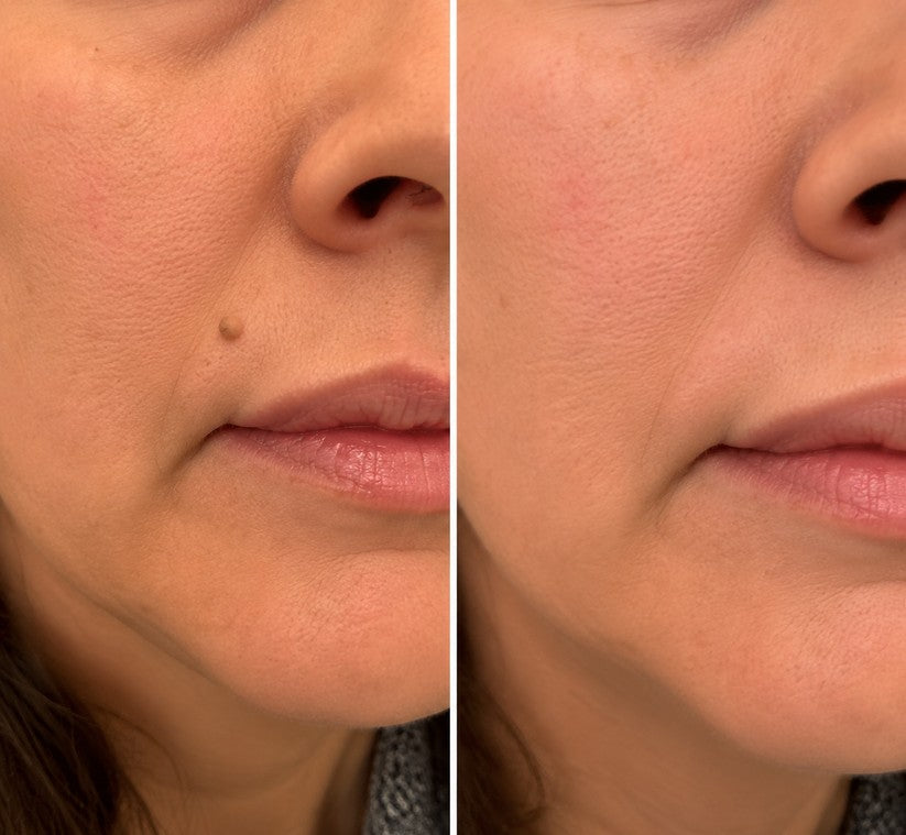 tryskintle® 2-in-1 Microneedle & Hydrocolloid Patch 🌿 Invisible Face & Body Patches for Raised Moles, Acne, Flat Warts & Skin Tags - Helps Improve the Appearance of Wrinkles, Scars & Blemishes