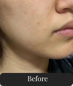 Before treatment