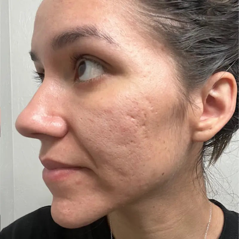 Skin after the first treatment