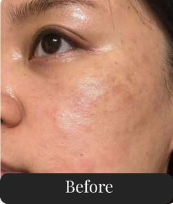 Before treatment