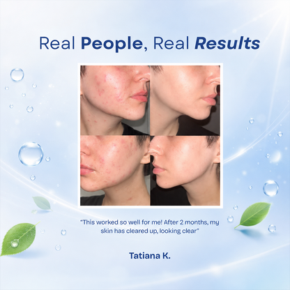 Acne Treatment-Pimples Removal Cream Pair