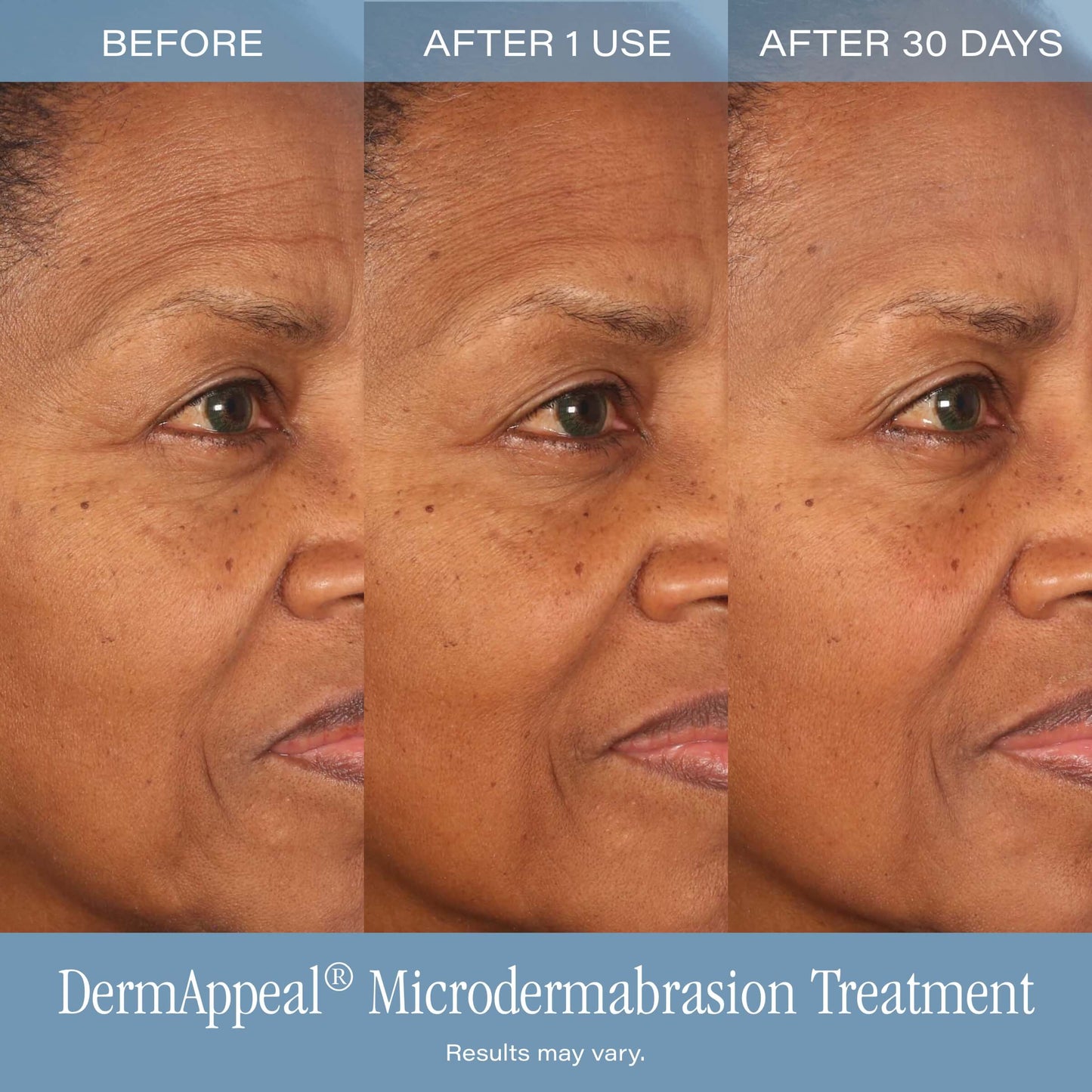 Microdermabrasion Treatment w/ V5 Crystal Technology Facial Exfoliate