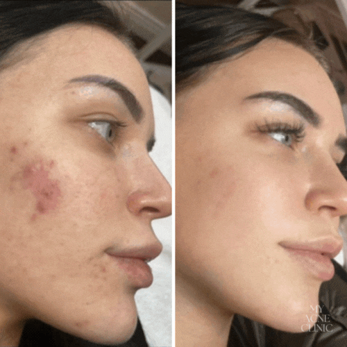 acne_cream.gif