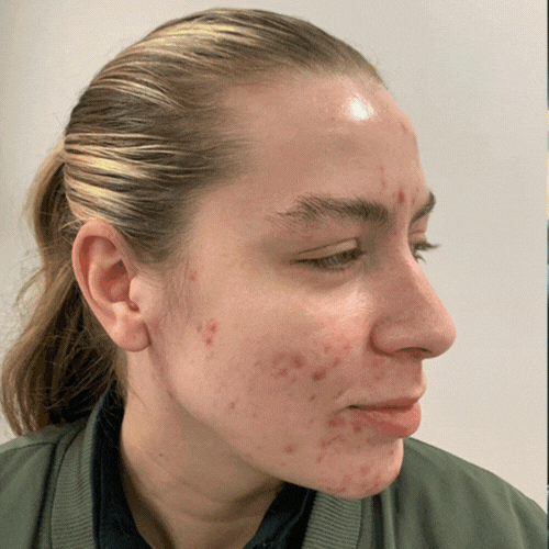 acne_cream_1.gif