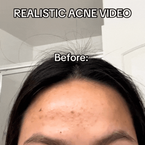 acne_cream_4.gif