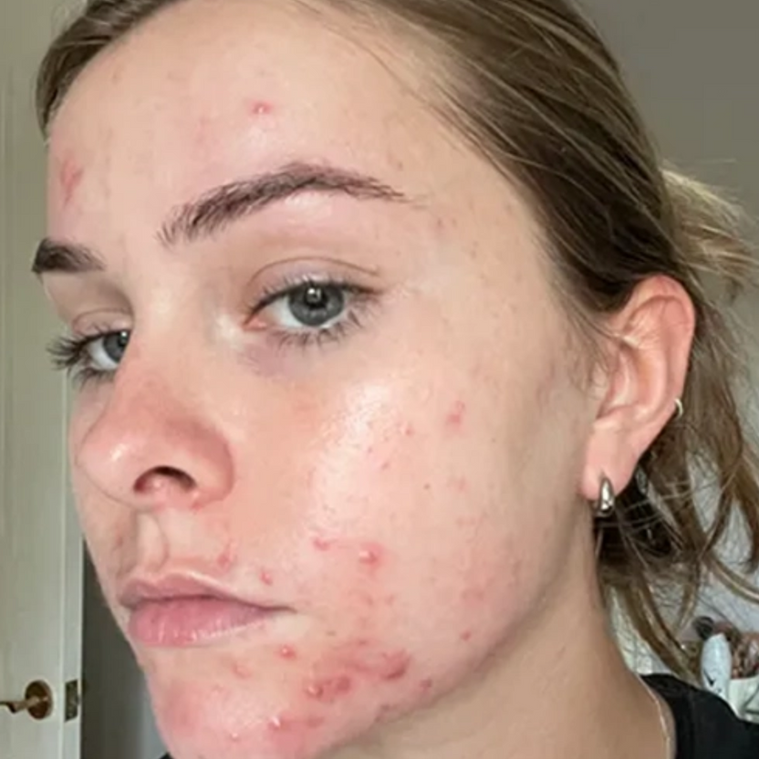 acne_cream_5.png
