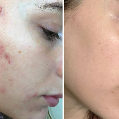 acne_cream_7.png