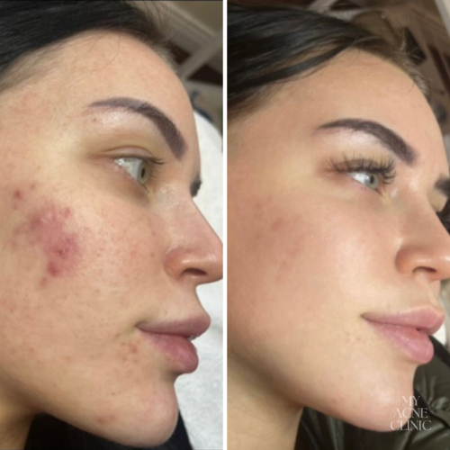 acne_cream_8.png