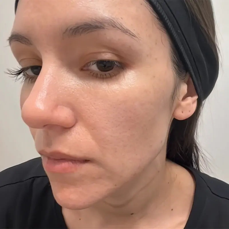 Skin after completing the protocol