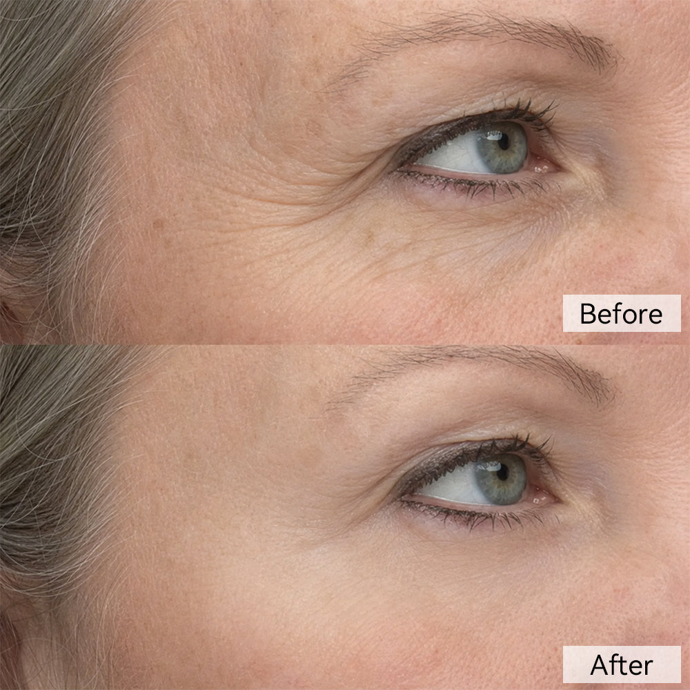 Her Concern: Crow’s Feet — before and after comparison
