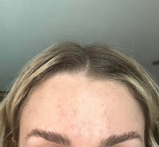 fungal-acne-healed-heres-how-i-did-it-v0-wje2uylzh3gd1.jpg