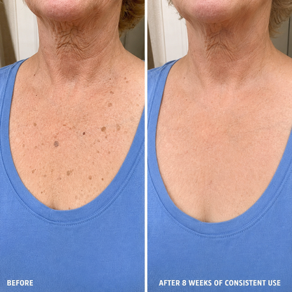 Advanced Keratolytic Cream For Rough, Raised Seborrheic Keratoses