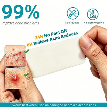 Hydrocolloid Acne Patch Roll – Cut to Any Size, 2 in × 16 ft