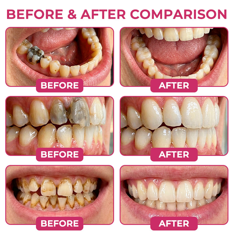 DenPerm Cavity-Repair Natural Enamel Filling Gel