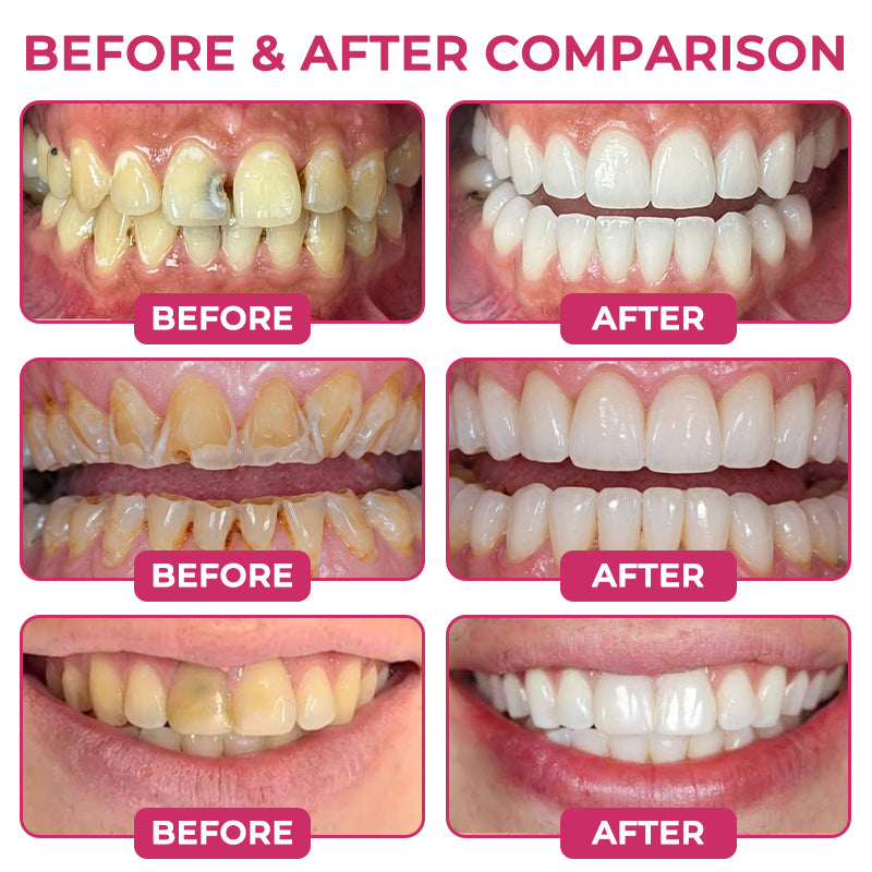 DenPerm Cavity-Repair Natural Enamel Filling Gel